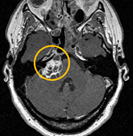 MRI scan of a Vestibular Schwannoma